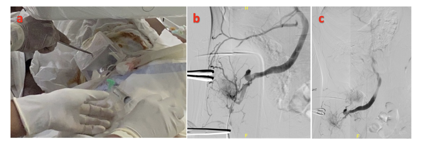 Percutaneous Glue Embolization of Ectopic Varices VDM